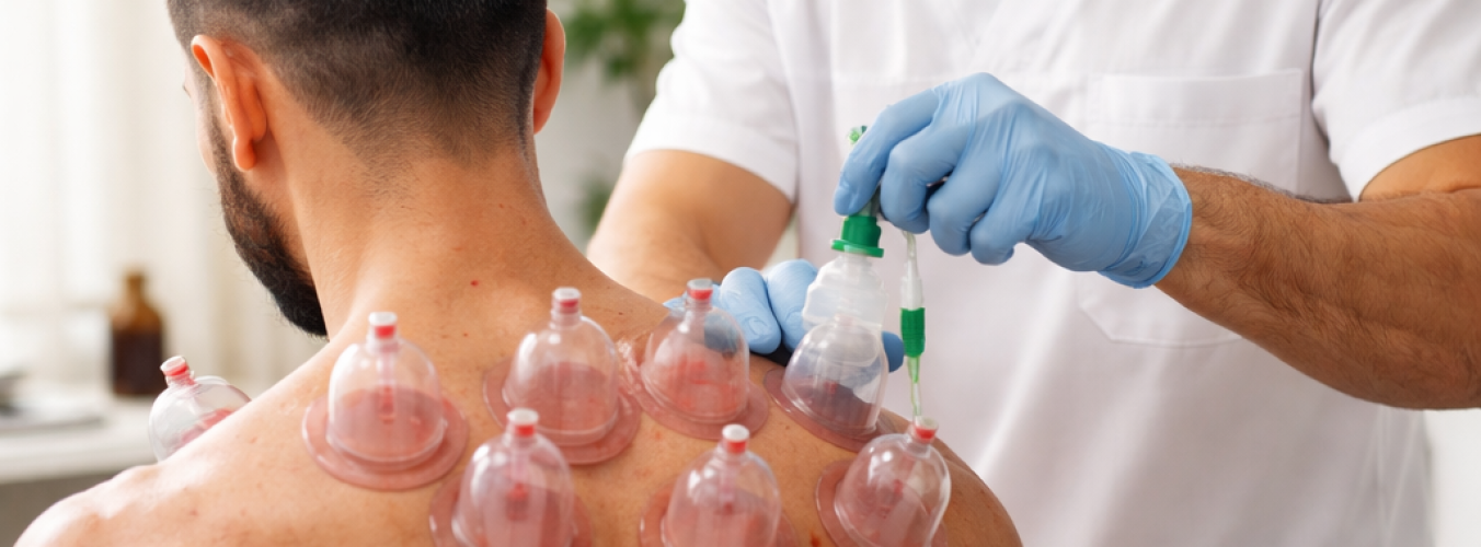 cupping therapy image